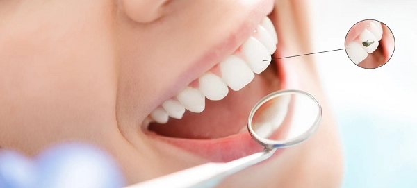 Реставрация зубов: показания, способы, этапы