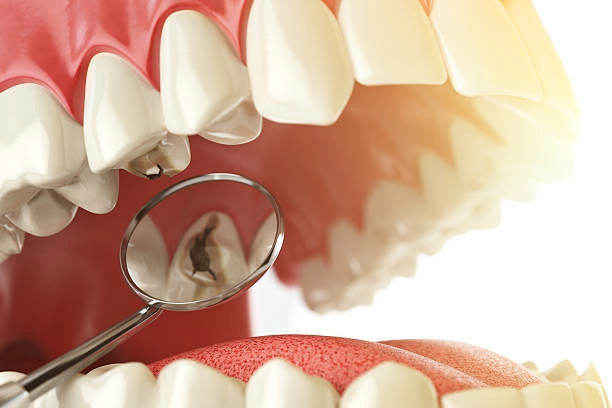 Что делать, если выпала пломба из зуба?